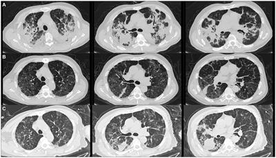 Case report: Suspected organizing pneumonia secondary to severe respiratory syncytial virus pneumonia in an elderly patient